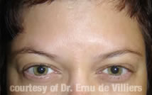 Botox03After