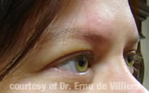 Botox04After