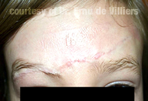 MicroNeedling03After